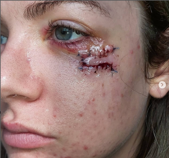 skin cancer